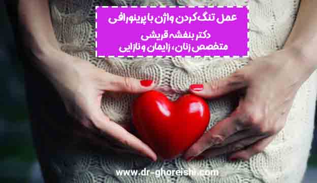 عمل-تنگ-کردن-واژن-با-پرینورافی