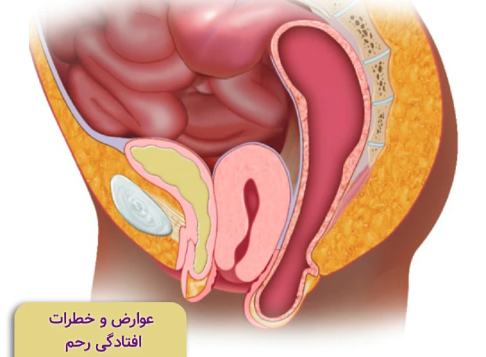 آیا افتادگی رحم خطرناک است